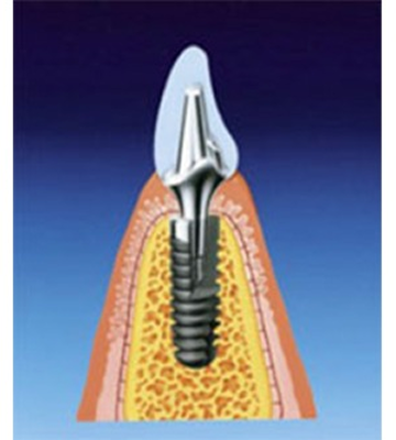 implant_image03