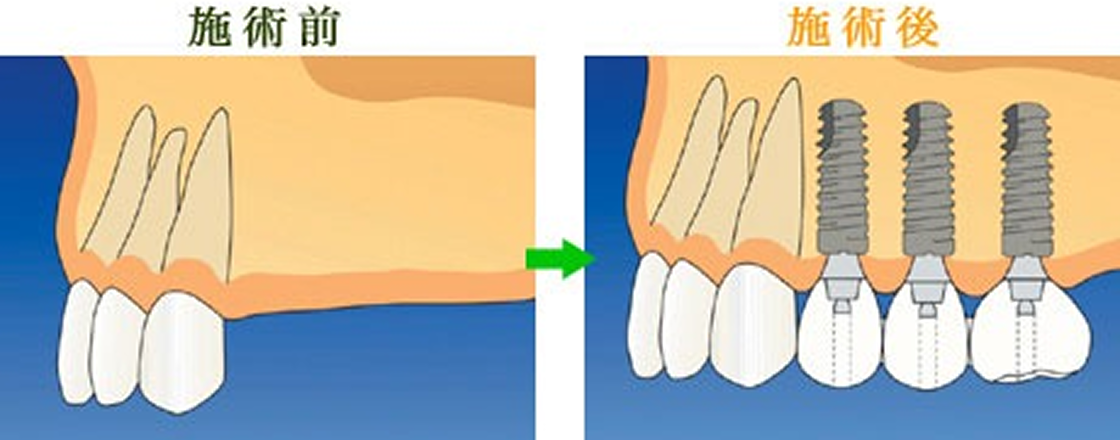implant_image10