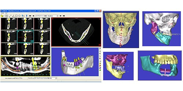 implant_image11