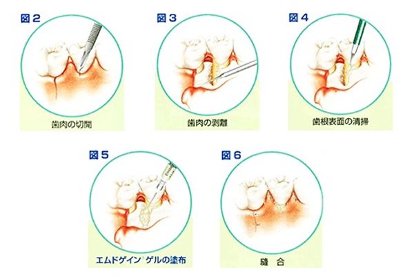 periodontal_image06